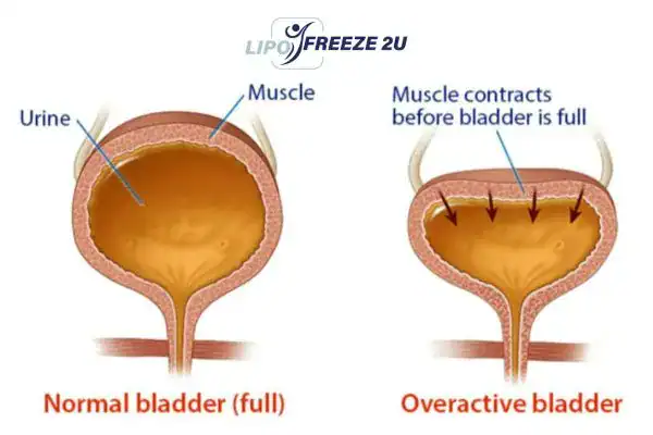 diagram of overactive bladder treatment Hampstead