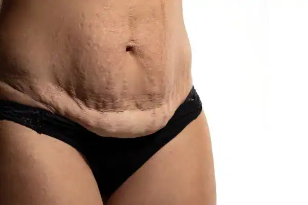 loose skin after weight loss injections Hampstead