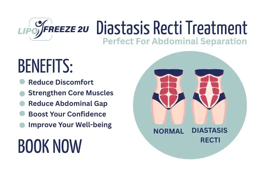 How Long Will It Take to See Improvements in Diastasis Recti Hampstead