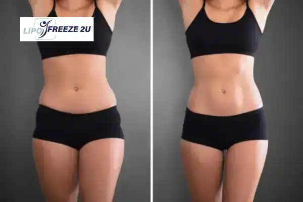 How Can LIPO FREEZE 2U Support Your Post-Pregnancy Body Recovery Hampstead?