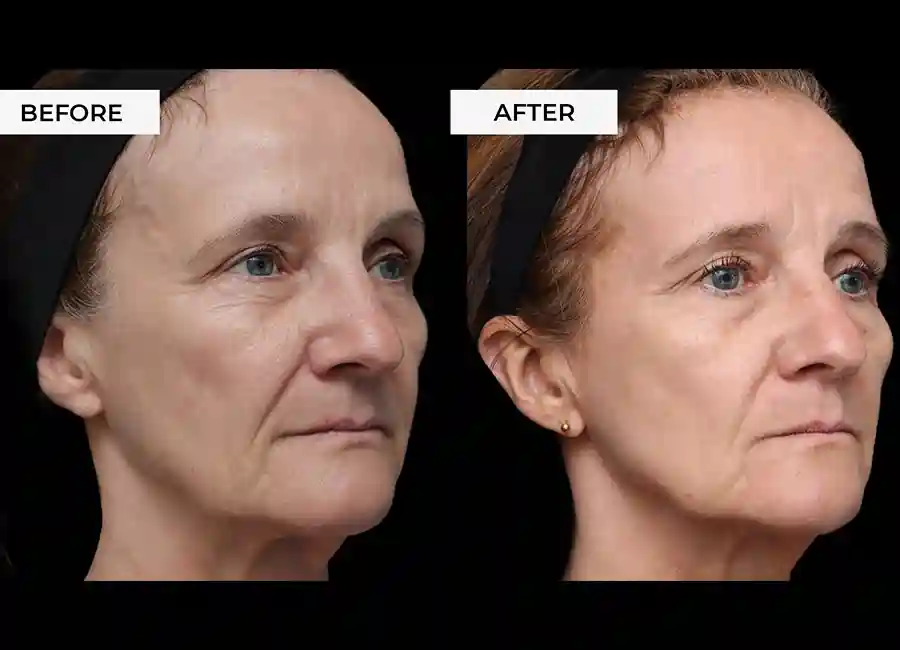 How Many RF Microneedling Sessions Will You Need to See a Difference Hampstead?