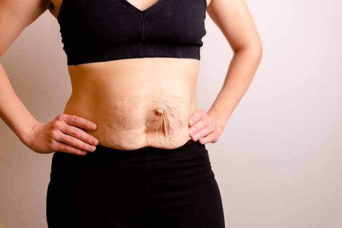 Is Surgery Really the Only Way to Repair Diastasis Recti Hampstead?