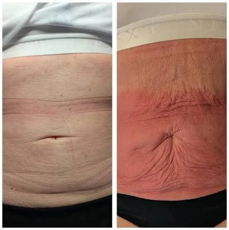 How Does RF Microneedling Improve Crepey, Thin and Uneven Skin Texture Hampstead?