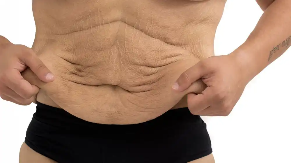 Why Does Weight Loss Medication Leave Some People With Loose or Sagging Skin Hampstead?